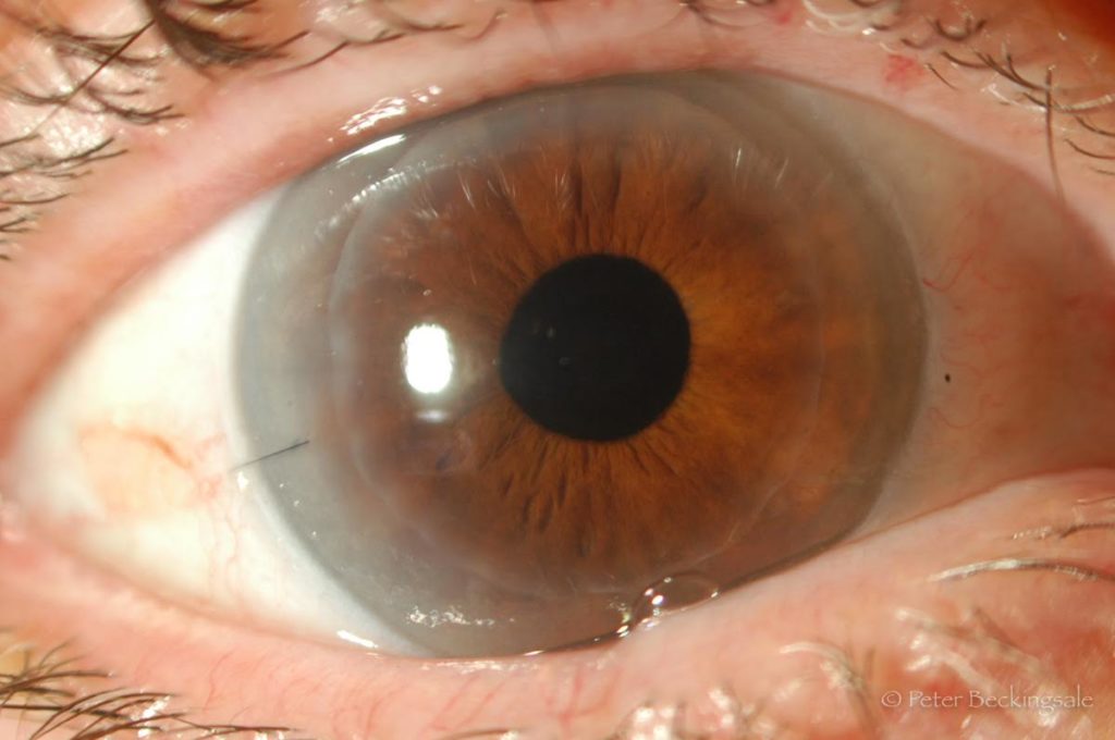 corneal-endothelial-transplant-dsek-dsaek-terrace-eye-centre