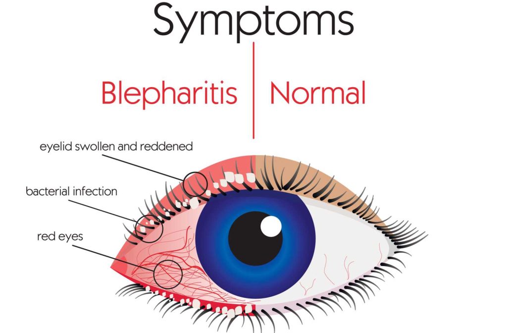 blepharitis