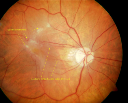 Epiretinal Membrane