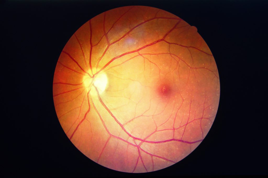 Macular Hole