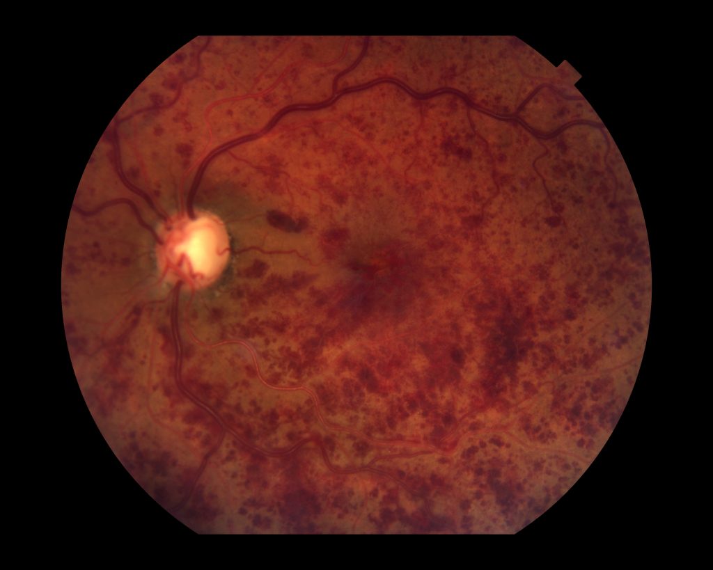 Retinal Vein Occlusion